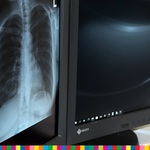 Prześwietlenie płuc widoczne na monitorze